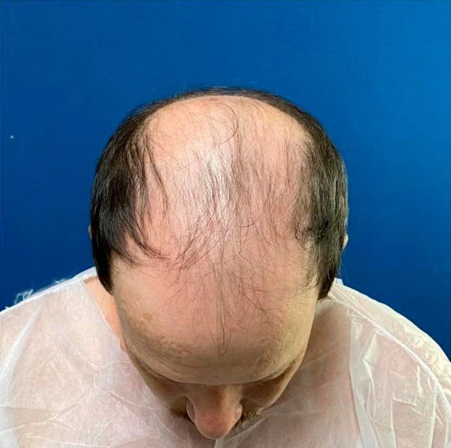 Antes do transplante capilar: região superior com menor densidade