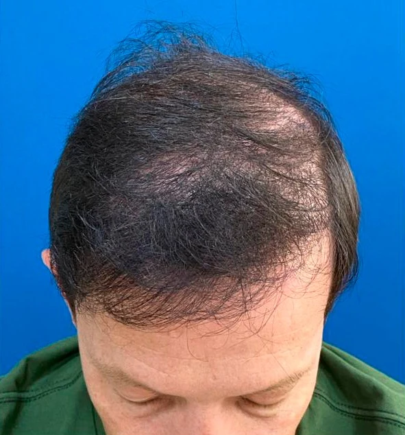 Depois do transplante capilar: região superior com maior densidade