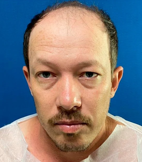 Antes do transplante capilar: região frontal com menor densidade