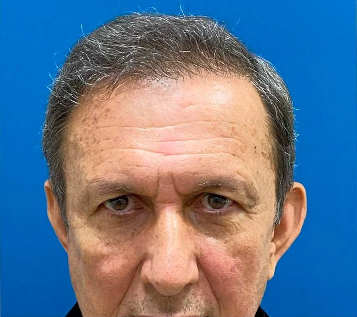 Depois do transplante capilar: região frontal com maior densidade