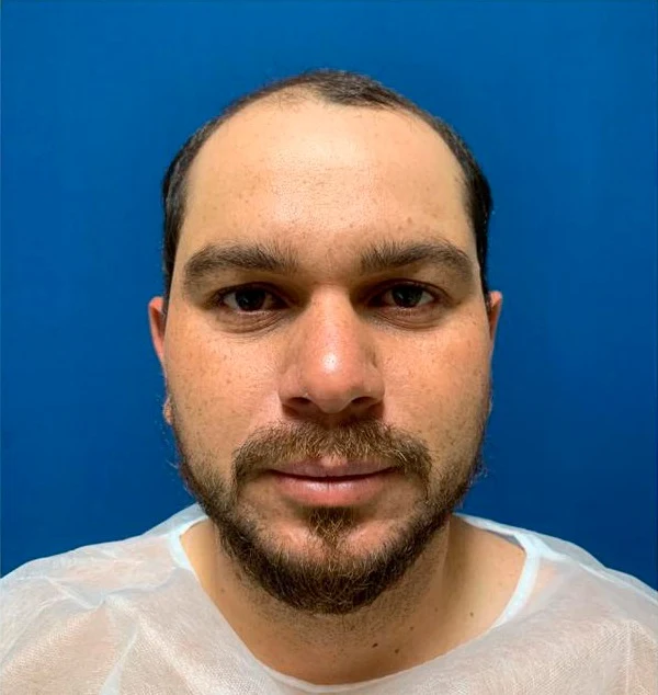 Antes do transplante capilar: linha frontal com menor densidade