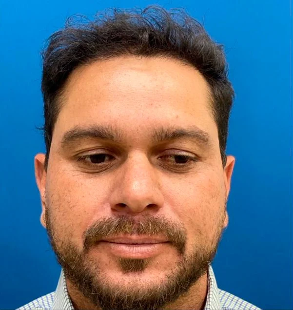 Depois do transplante capilar: linha frontal com maior densidade