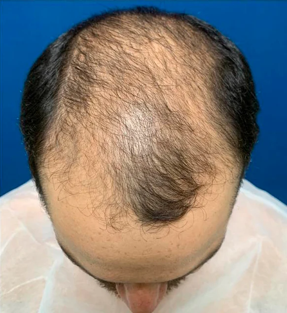 Antes do transplante capilar: região superior com menor densidade