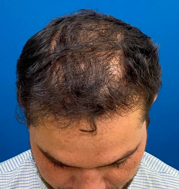 Depois do transplante capilar: região superior com maior densidade