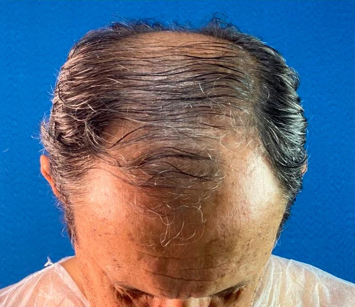 Antes do transplante capilar: região superior com menor densidade