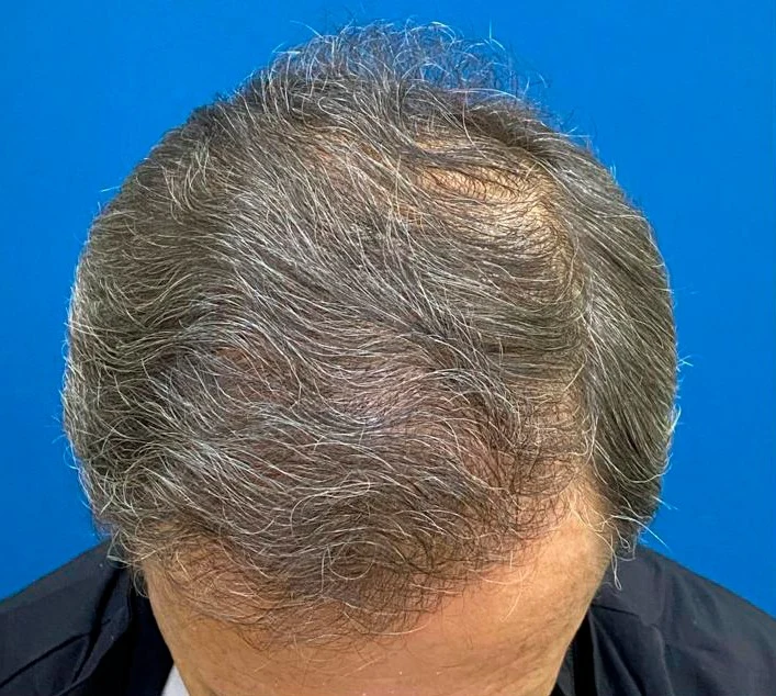 Depois do transplante capilar: região superior com maior densidade